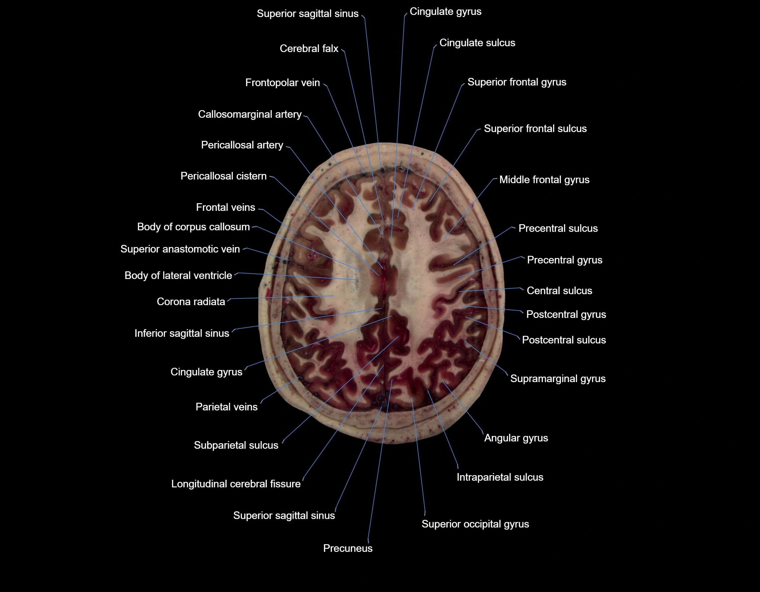 MRI Brain axial cross sectional radiology anatomy 3T image  -img-000057.webp